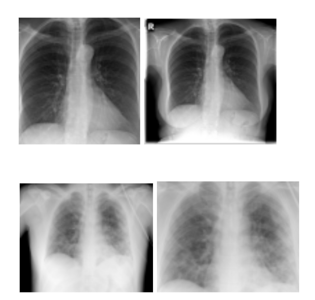 Chest X-Ray Disease Classification With Deep Learning and Dataiku