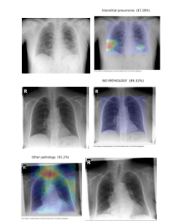chest x-rays